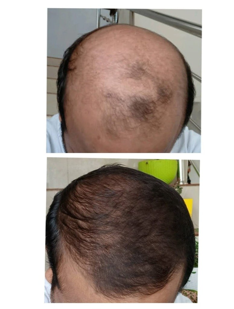 पुरुष हेयर रीग्रोथ Before After परिणाम